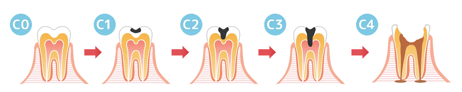 虫歯の進行のイメージ画像