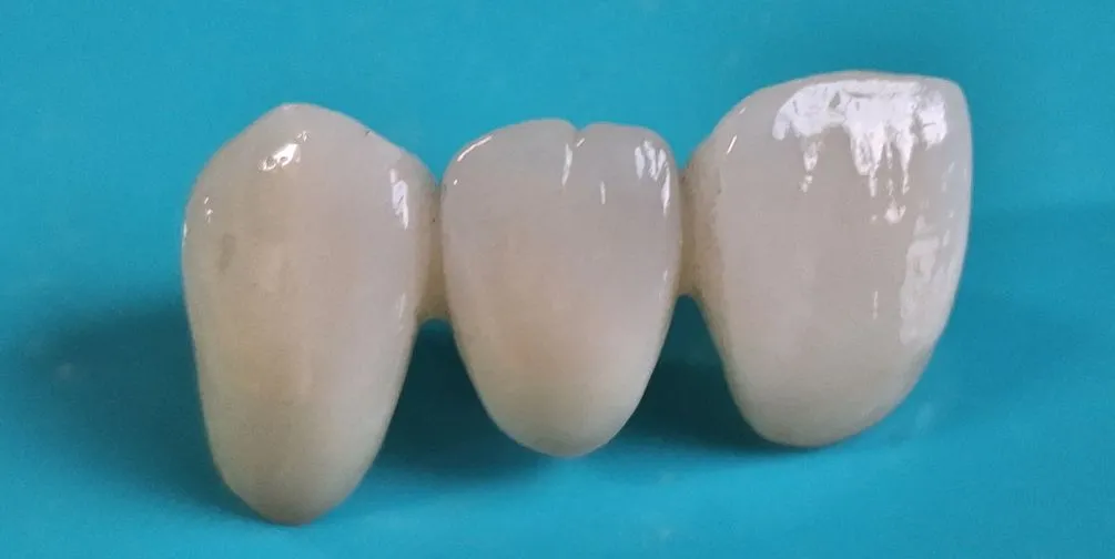 被せもの・詰め物