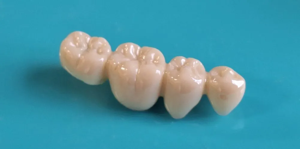 被せもの・詰め物